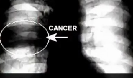 L'idea che sta dietro a questo genere di ricerche è ben nota a tutti gli oncologi: il tumore prospera in ambiente acido ed anzi lo genera attorno a sé, con ciò favorendo le metastasi.